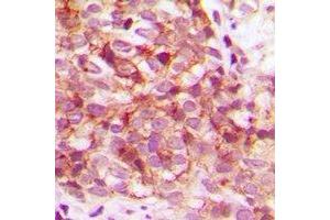 Immunohistochemical analysis of CDK15 staining in human breast cancer formalin fixed paraffin embedded tissue section. (Cyclin-Dependent Kinase 15 (ALS2CR7) 抗体)