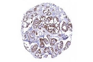 Breast Adenoid cystic breast cancer with strong membranous mesothelin immunostaining in a subset of cells (Mesothelin 抗体  (AA 273-407))