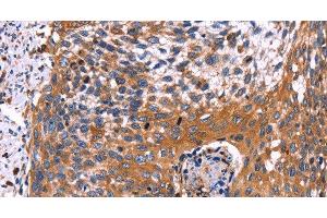 Immunohistochemistry of paraffin-embedded Human cervical cancer using RDX Polyclonal Antibody at dilution of 1:60 (Radixin 抗体)