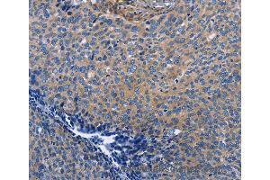 Immunohistochemistry of Human cervical cancer using INTS10 Polyclonal Antibody at dilution of 1:50 (INTS10 抗体)