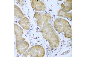Immunohistochemistry of paraffin-embedded human gastric cancer using IGF2BP3 antibody (ABIN5971465) at dilution of 1/100 (40x lens). (IGF2BP3 抗体)