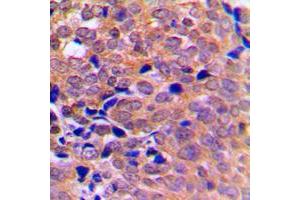 Immunohistochemical analysis of AMPK alpha 1/2 staining in human breast cancer formalin fixed paraffin embedded tissue section. (PRKAA1/PRKAA2 抗体  (Center))