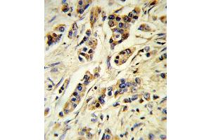 Formalin-fixed and paraffin-embedded human breast carcinoma reacted with IL10 Antibody (Center), which was peroxidase-conjugated to the secondary antibody, followed by DAB staining. (IL-10 抗体  (AA 27-53))