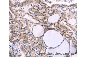 Immunohistochemistry of Human thyroid cancer using IL1RL1 Polyclonal Antibody at dilution of 1:40 (IL1RL1 抗体)