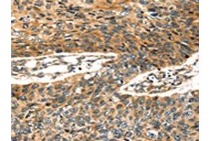 The image on the left is immunohistochemistry of paraffin-embedded Human esophagus cancer tissue using ABIN7128026(STX19 Antibody) at dilution 1/35, on the right is treated with fusion protein. (Syntaxin 19 抗体)