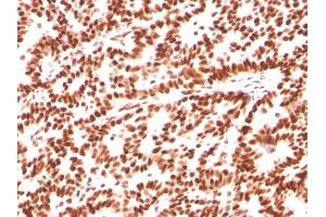 Formalin-fixed, paraffin-embedded human Breast Carcinoma stained with Estrogen Receptor alpha Mouse Monoclonal Antibody (ESR1/3559). (Estrogen Receptor alpha 抗体  (AA 129-312))