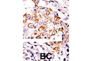 Formalin-fixed and paraffin-embedded human cancer tissue reacted with NME3 polyclonal antibody  , which was peroxidase-conjugated to the secondary antibody, followed by DAB staining. (NME3 抗体  (Internal Region))