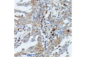 Immunohistochemistry of paraffin-embedded human lung cancer using MEKK3 antibody (ABIN7268652) at dilution of 1:100 (40x lens). (MAP3K3 抗体  (AA 1-220))