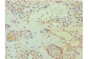 Immunohistochemistry of paraffin-embedded human breast cancer using ABIN7172529 at dilution of 1:100 (E2F6 抗体  (AA 1-281))