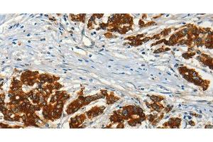 Immunohistochemistry of paraffin-embedded Human colon cancer using ADCY3 Polyclonal Antibody at dilution of 1:50 (ADCY3 抗体)
