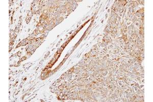 IHC-P Image Immunohistochemical analysis of paraffin-embedded human lung SCC, using HSP22, antibody at 1:500 dilution. (HSPB8 抗体  (C-Term))