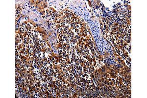 Immunohistochemistry of Human tosil  using IL17RC Polyclonal Antibody at dilution of 1:30 (IL17RC 抗体)
