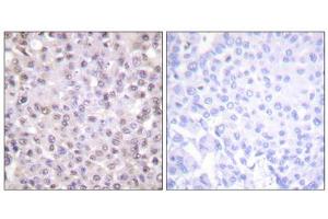 Immunohistochemistry analysis of paraffin-embedded human breast carcinoma, tissue using NCoR1 antibody. (NCOR1 抗体  (N-Term))