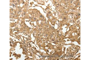 Immunohistochemistry of Human lung cancer using TXN Polyclonal Antibody at dilution of 1:40 (TXN 抗体)