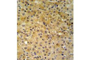 Immunohistochemistry analysis in formalin fixed and paraffin embedded hepatocarcinoma reacted with NDUFA10 Antibody (Center) followed which was followed by peroxidase conjugated to the secondary antibody and DAB staining. (NDUFA10 抗体  (Middle Region))