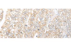Immunohistochemistry of paraffin-embedded Human gastric cancer tissue using NME4 Polyclonal Antibody at dilution of 1:45(x200) (NME4 抗体)