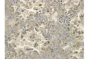 ABIN6265511 and ABIN6272444 at 1/100 staining human melanoma by IHC-P. (SERINC3 抗体  (C-Term))