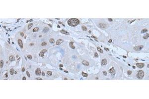 Immunohistochemistry of paraffin-embedded Human esophagus cancer tissue using HAND1 Polyclonal Antibody at dilution of 1:30(x200) (HAND1 抗体)