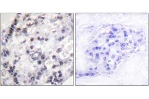 Immunohistochemistry analysis of paraffin-embedded human breast carcinoma tissue, using hnRNP C1/2 (Ab-260) Antibody. (HNRNPC 抗体  (AA 231-280))