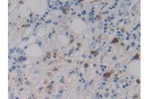 Detection of MASP1 in Human Skin cancer Tissue using Polyclonal Antibody to Mannose Associated Serine Protease 1 (MASP1) (MASP1 抗体  (AA 20-447))