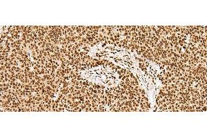 Immunohistochemistry of paraffin-embedded Human ovarian cancer tissue using GRSF1 Polyclonal Antibody at dilution of 1:30(x200) (GRSF1 抗体)