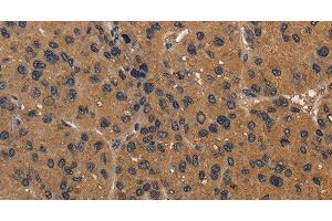 Immunohistochemistry of paraffin-embedded Human liver cancer using CD242 Polyclonal Antibody at dilution of 1:50 (ICAM4 抗体)