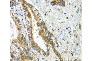 Immunohistochemistry of paraffin-embedded Human liver cancer using CDC16 Polyclonal Antibody at dilution of 1:100 (40x lens). (CDC16 抗体)
