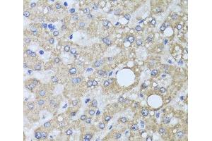 Immunohistochemistry of paraffin-embedded Human liver damage using AARS2 Polyclonal Antibody at dilution of 1:100 (40x lens). (AARS2 抗体)