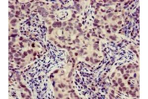 Immunohistochemistry of paraffin-embedded human pancreatic cancer using ABIN7175883 at dilution of 1:100 (XBP1 抗体  (AA 1-167))