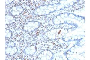 Formalin-fixed, paraffin-embedded human Colon Carcinoma stained with BMI1-Monospecific Mouse Monoclonal Antibody (BMI1/2689). (BMI1 抗体  (AA 142-326))