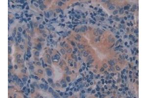 Detection of CAV1 in Human Thyroid cancer Tissue using Polyclonal Antibody to Caveolin 1 (CAV1) (Caveolin-1 抗体  (AA 2-104))