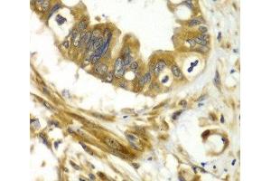 Immunohistochemistry of paraffin-embedded Human liver cancer using GBP1 Polyclonal Antibody at dilution of 1:100 (40x lens). (GBP1 抗体)