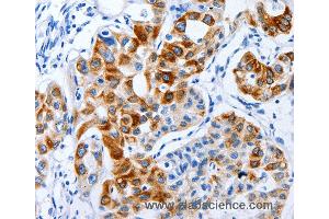 Immunohistochemistry of Human lung cancer using BPIFB3 Polyclonal Antibody at dilution of 1:120 (BPIFB3 抗体)