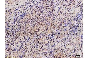 Formalin-fixed and paraffin embedded human nasopharyngeal carcinoma tissue labeled with Anti-Twist Polyclonal Antibody , and DAB staining (TWIST1, TWIST2 (AA 71-170) 抗体)