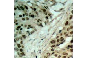 Immunohistochemical analysis of NAT5 staining in human ovarian cancer formalin fixed paraffin embedded tissue section. (NAT5 抗体)