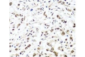 Immunohistochemistry of paraffin-embedded Human gastric cancer using HIRA Polyclonal Antibody at dilution of 1:100 (40x lens). (HIRA 抗体)