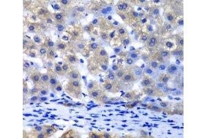 Immunohistochemistry of paraffin-embedded Human liver damage using PSMD8 Polyclonal Antibody at dilution of 1:100 (40x lens). (PSMD8 抗体)