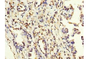 IHC image of ABIN7159260 diluted at 1:200 and staining in paraffin-embedded human lung cancer performed on a Leica BondTM system. (MAGEA3 抗体  (AA 2-104))
