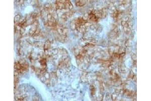 Formalin-fixed, paraffin-embedded human renal cell carcinoma stained with Cadherin 16 antibody (CDH16/1071) (Cadherin-16 抗体)