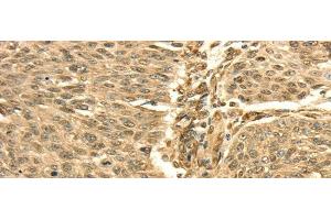 Immunohistochemistry of paraffin-embedded Human lung cancer using SEPT2 Polyclonal Antibody at dilution of 1/30 (Septin 2 抗体)