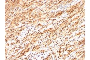 Formalin-fixed, paraffin-embedded human Schwanoma stained with S100B Rabbit Polyclonal Antibody. (S100B 抗体)