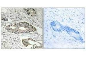 Immunohistochemistry analysis of paraffin-embedded human colon carcinoma tissue, using EPN3 antibody. (EPN3 抗体)