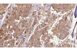 ABIN6278939 at 1/100 staining Human Melanoma tissue by IHC-P. (CYB5R4 抗体  (N-Term))