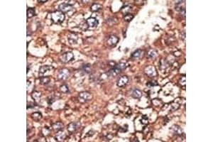 IHC analysis of FFPE human hepatocarcinoma tissue stained with the Leptin Receptor antibody