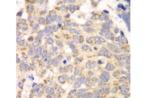 Immunohistochemistry of paraffin-embedded Human esophageal cancer using HAGH Polyclonal Antibody at dilution of 1:100 (40x lens). (HAGH 抗体)