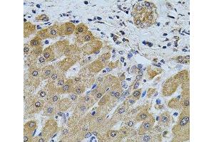Immunohistochemistry of paraffin-embedded Human liver damage using FoxO3a Polyclonal Antibody at dilution of 1:100 (40x lens). (FOXO3 抗体)