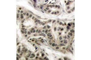 Immunohistochemistry of paraffin-embedded human breast carcinoma using Phospho-NFKB1-S337 antibody (ABIN2987371). (NFKB1 抗体  (pSer337))