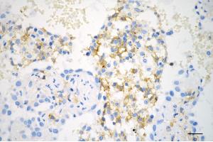 Immunohistochemistry was performed on paraffin-embedded human lung adenocarcinoma using phospho-PKC alpha (T497) antibody (ABIN7799986), 1:200).