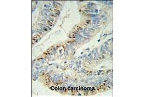 PHL Antibody (C-term) (ABIN652395 and ABIN2841923) IHC analysis in formalin fixed and paraffin embedded colon carcinoma followed by peroxidase conjugation of the secondary antibody and DAB staining. (PHLPP2 抗体  (C-Term))