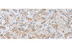 Immunohistochemistry of paraffin-embedded Human liver cancer tissue using DHX58 Polyclonal Antibody at dilution of 1:60(x200) (DHX58 抗体)
